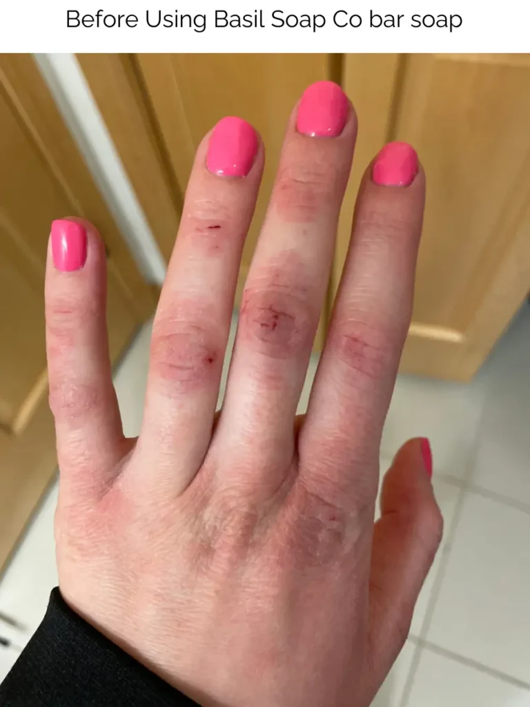 Hands red and bloody before using Basil Soap Co handmade soap